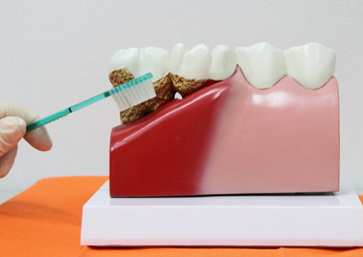 Simulation de tartre sous-gingival