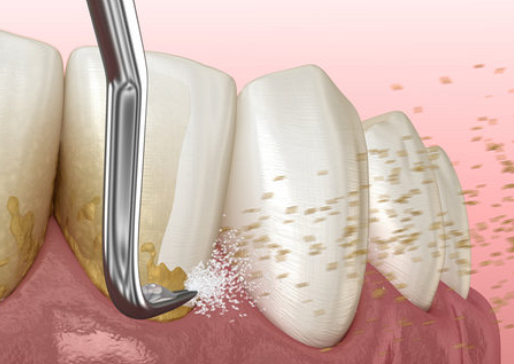 Simulation de tartre supra-gingival