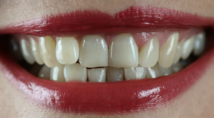 Quelles sont les solutions pour des dents qui se chevauchent ?