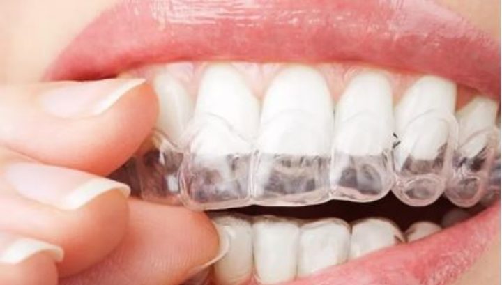 Orthodontie Invisalign, qu’est-ce qui fait son succès ?